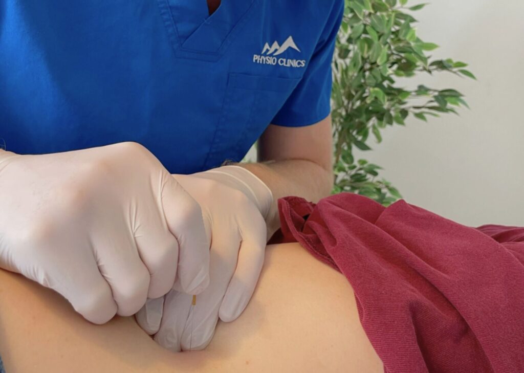 Séance de dry needling par un physiothérapeute chez Physio Clinics