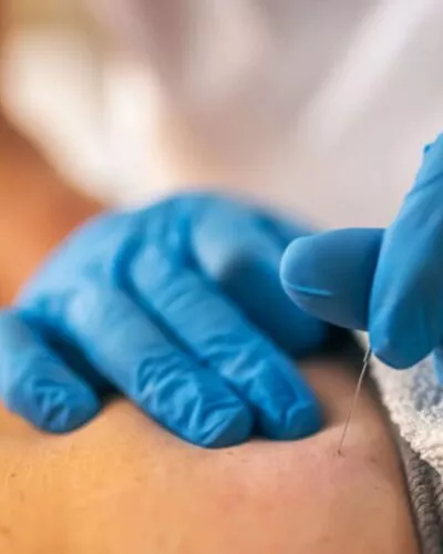 Traitement de physiothérapie sur les points gâchettes, aussi appelés trigger points chez Physio Clinics Penthalaz
