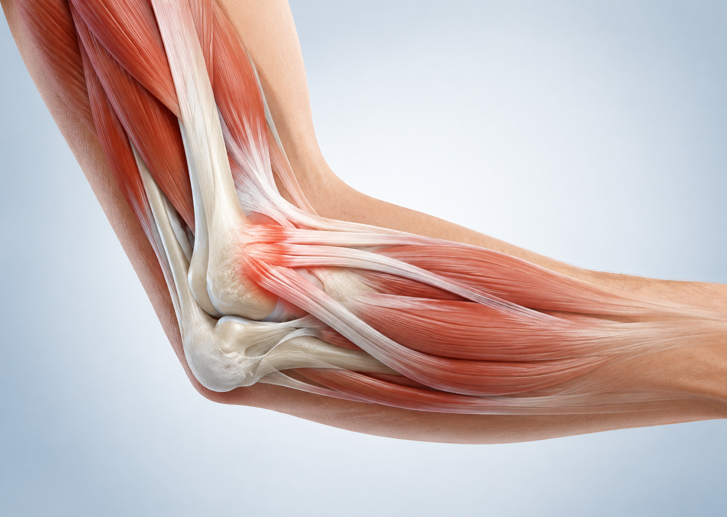Illustration anatomique d’un coude montrant les muscles et les tendons, avec une zone douloureuse liée à une tendinite (épicondylite).